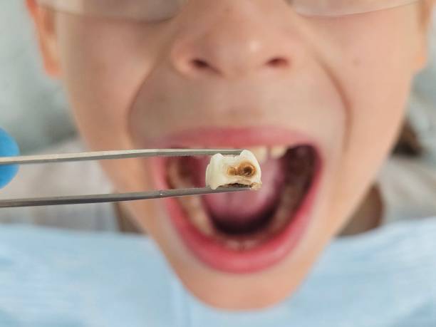 Best Emergency Tooth Extraction in Euharlee, GA